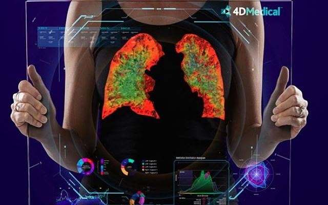 4DMedical secures Australian TGA approval for XV Lung Ventilation Analysis software ahead of schedule