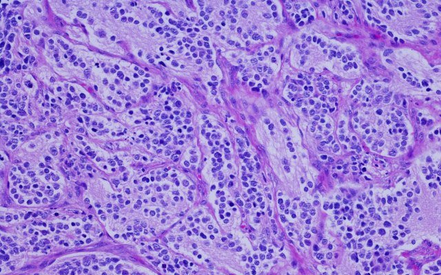 Amplia Therapeutics confirms anti-cancer drug AMP945 can inhibit focal adhesion kinase in healthy volunteers