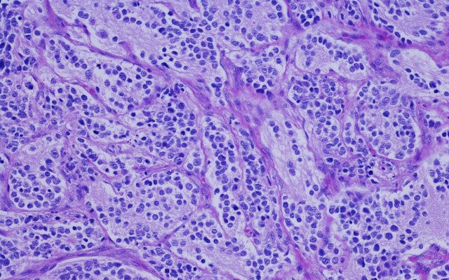 Amplia Therapeutics confirms anti-cancer drug AMP945 can inhibit focal adhesion kinase in healthy volunteers