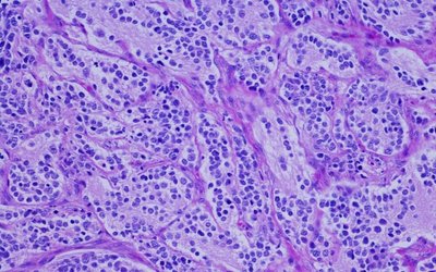 Amplia Therapeutics confirms anti-cancer drug AMP945 can inhibit focal adhesion kinase in healthy volunteers