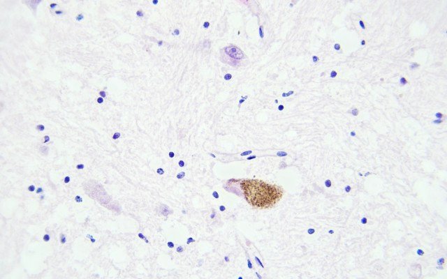 Animal data shows potential for Patrys’ PAT-DX1 drug to help radiation fight aggressive brain tumours