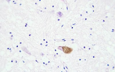 Animal data shows potential for Patrys’ PAT-DX1 drug to help radiation fight aggressive brain tumours