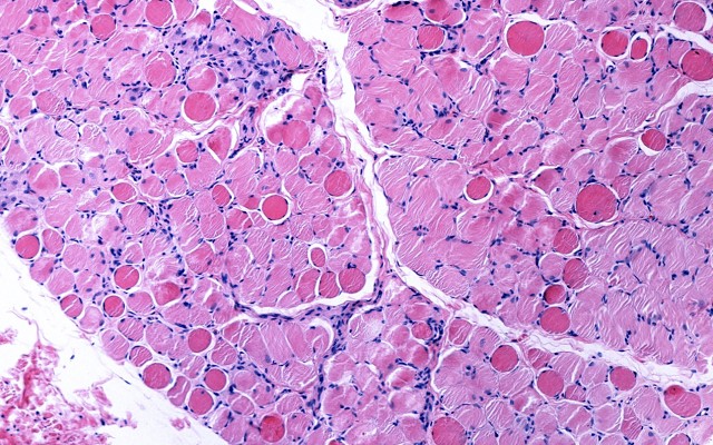 Antisense Therapeutics reports ‘strong initial efficacy’ for Duchenne Muscular Dystrophy drug in Phase 2 trial