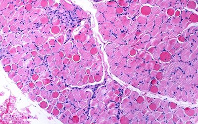 Antisense Therapeutics reports ‘strong initial efficacy’ for Duchenne Muscular Dystrophy drug in Phase 2 trial