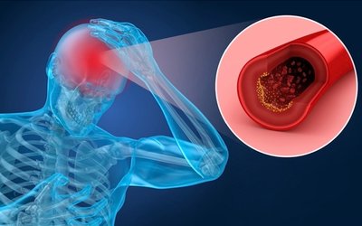 Argenica Therapeutics records positive results from ARG-007 study into cerebral ischaemia