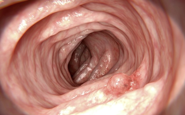 Bionomics and US drugmaker Bristol-Myers Squibb kick off experimental cancer trial