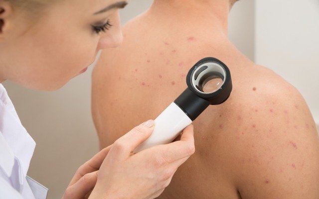 Botanix receives FDA go-ahead for progressive acne treatment