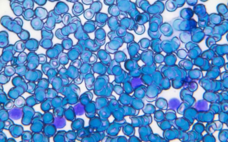 Chimeric Therapeutics begins innovative therapy trial for acute myeloid leukaemia