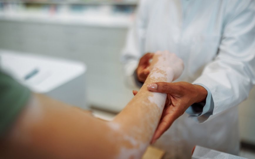 Clinuvel Pharmaceuticals reaches patient recruitment milestone ahead of Phase III Scenesse vitiligo trial
