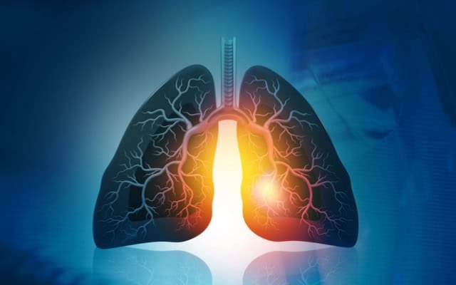 Hoth Therapeutics’ HT-004 treatment shows potential in reducing lung inflammation