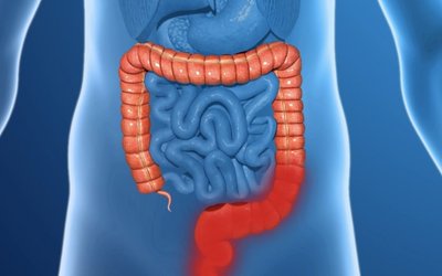 Immuron takes aim at the rapid growth of autoimmune diseases