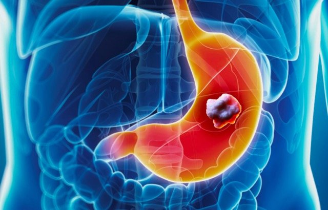 Imugene commences first patient dosing for HER-Vaxx gastric cancer study