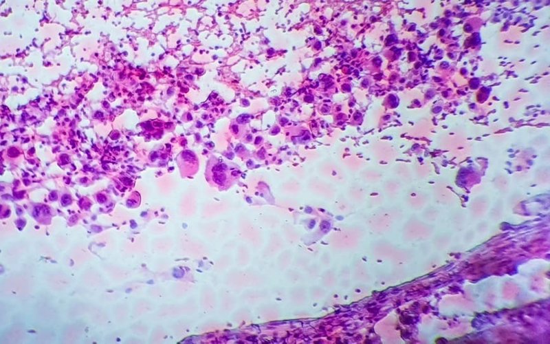 Imugene granted Japanese patent for PD1-Vaxx to treat non-small cell lung cancer