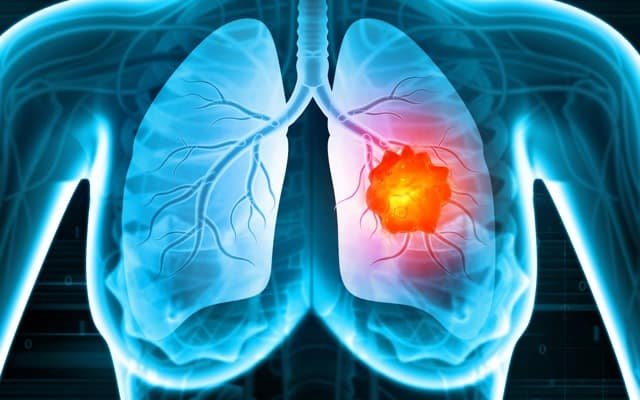 Imugene and Roche partner to evaluate PD1-Vaxx with Tecentriq for non-small cell lung cancer