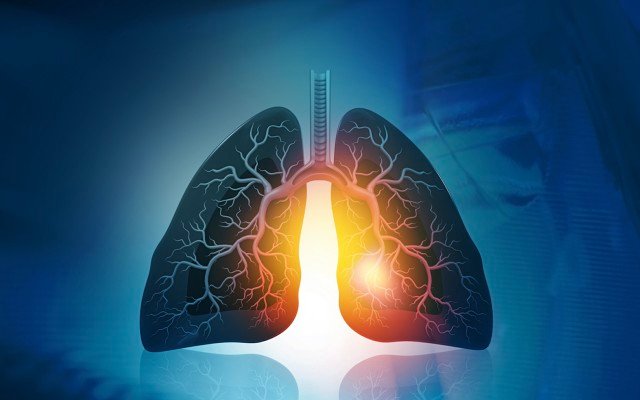 Incannex Healthcare plans US regulatory pathway for IHL-675A in treating multiple inflammatory conditions
