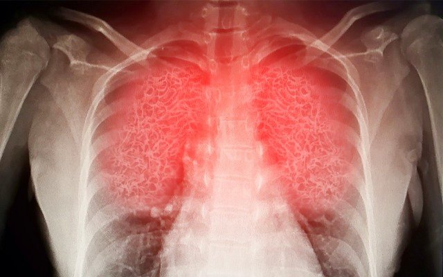 Incannex announces in vitro results from sepsis-associated acute respiratory disease drug studies