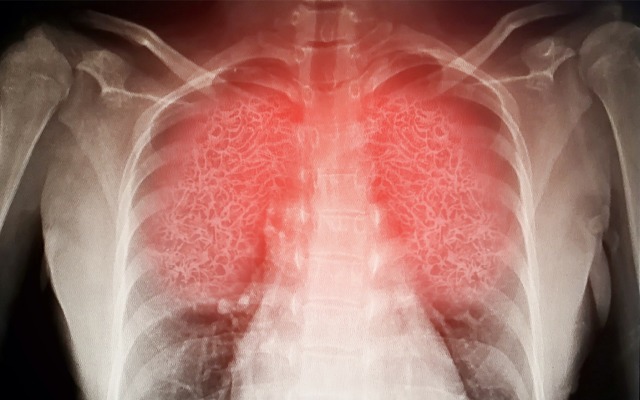 Incannex announces in vitro results from sepsis-associated acute respiratory disease drug studies