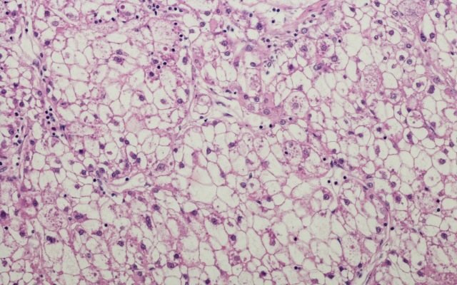 Invitrocue’s Onco-PDO technology grows liver cancer outside of body