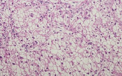 Invitrocue’s Onco-PDO technology grows liver cancer outside of body