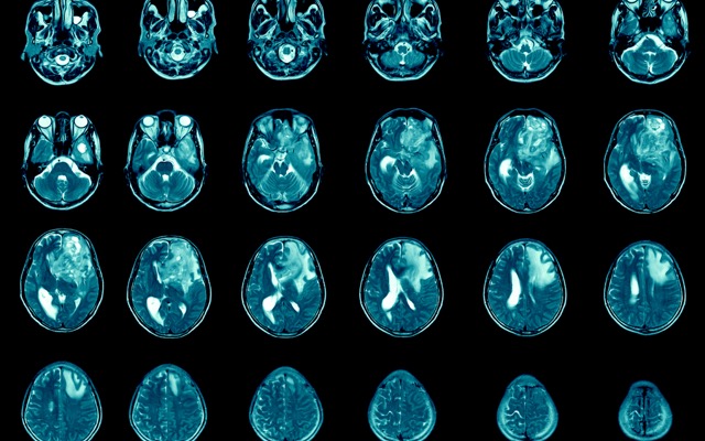 Kazia Therapeutics adds recruitment sites to paxalisib arm of global glioblastoma study