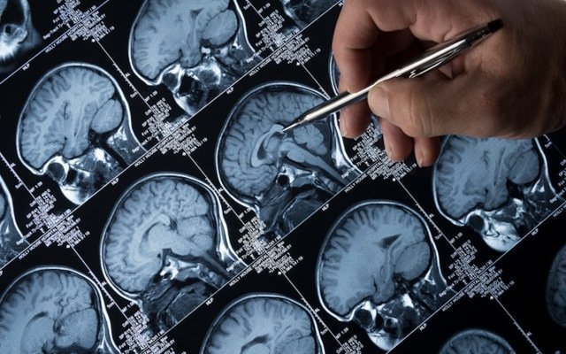 Kazia Therapeutics commences clinical trial to redress the balance in glioblastoma treatment options