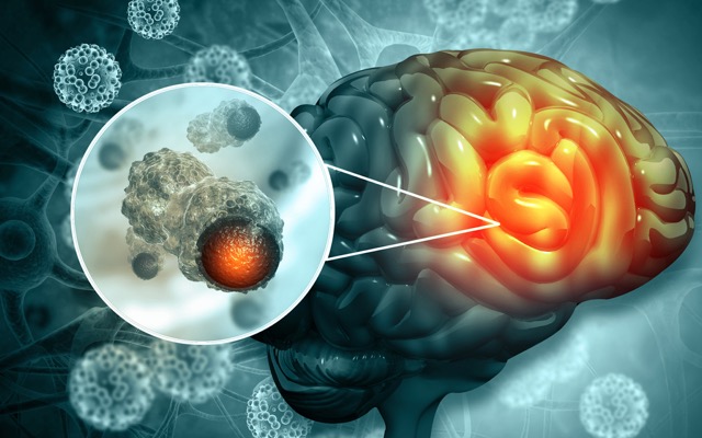 Kazia Therapeutics presents ‘positive data’ on paxalisib in childhood brain cancers