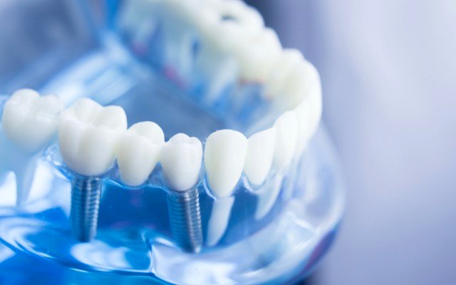 Orthocell’s CelGro bone regeneration device accelerates dental implant treatment timeframes, cuts costs