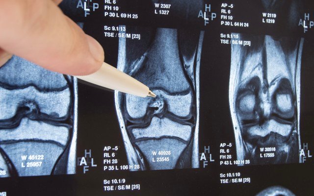 Paradigm Biopharma’s knee osteoarthritis trial meets secondary endpoints, launches capital raise