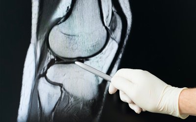 Paradigm Biopharma’s knee osteoarthritis trial shows injectable drug can slow cartilage degradation