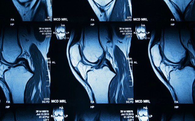 Paradigm Biopharmaceuticals’ iPPS drug reduces bone marrow lesions in hip, knee caps and ankles