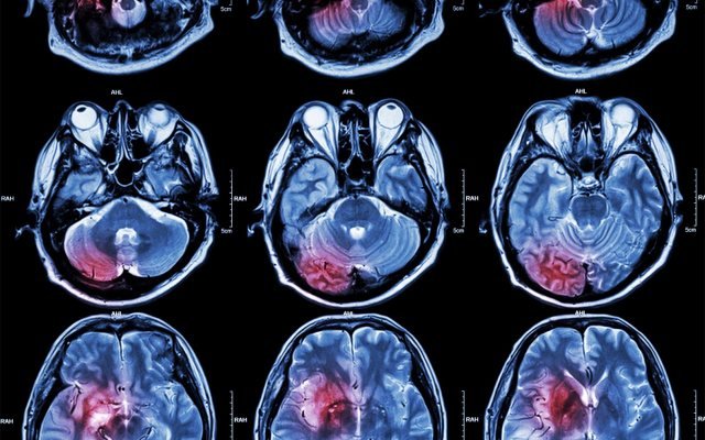 Patrys publishes upbeat pre-clinical data in the fight against brain cancer