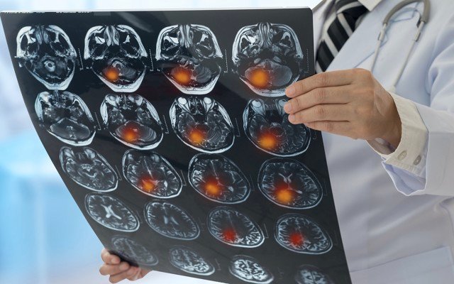 Prescient Therapeutics appoints leading brain cancer specialist to advisory board