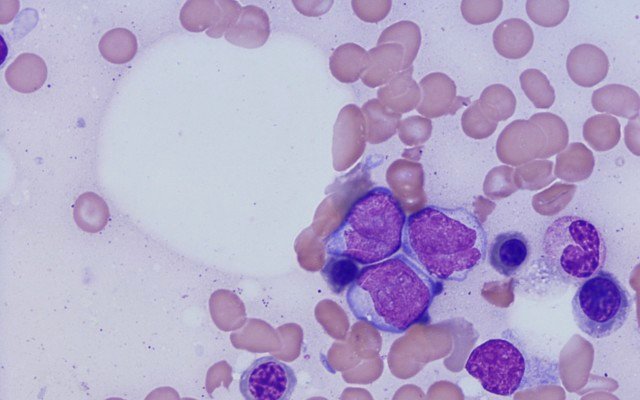 Prescient Therapeutics expands study after completely eradicating cancer in patients