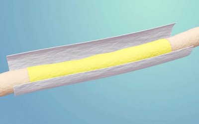 ReNerve study shows major patient outcome benefits of NervAlign nerve cuff